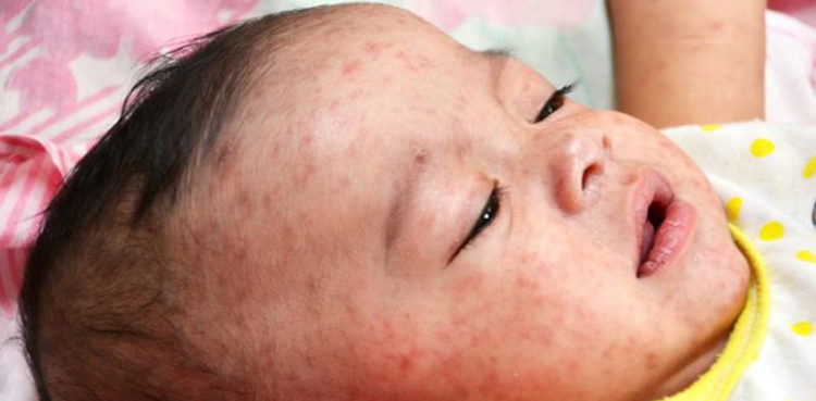 child-in-jacobabad-dies-of-measles-sources