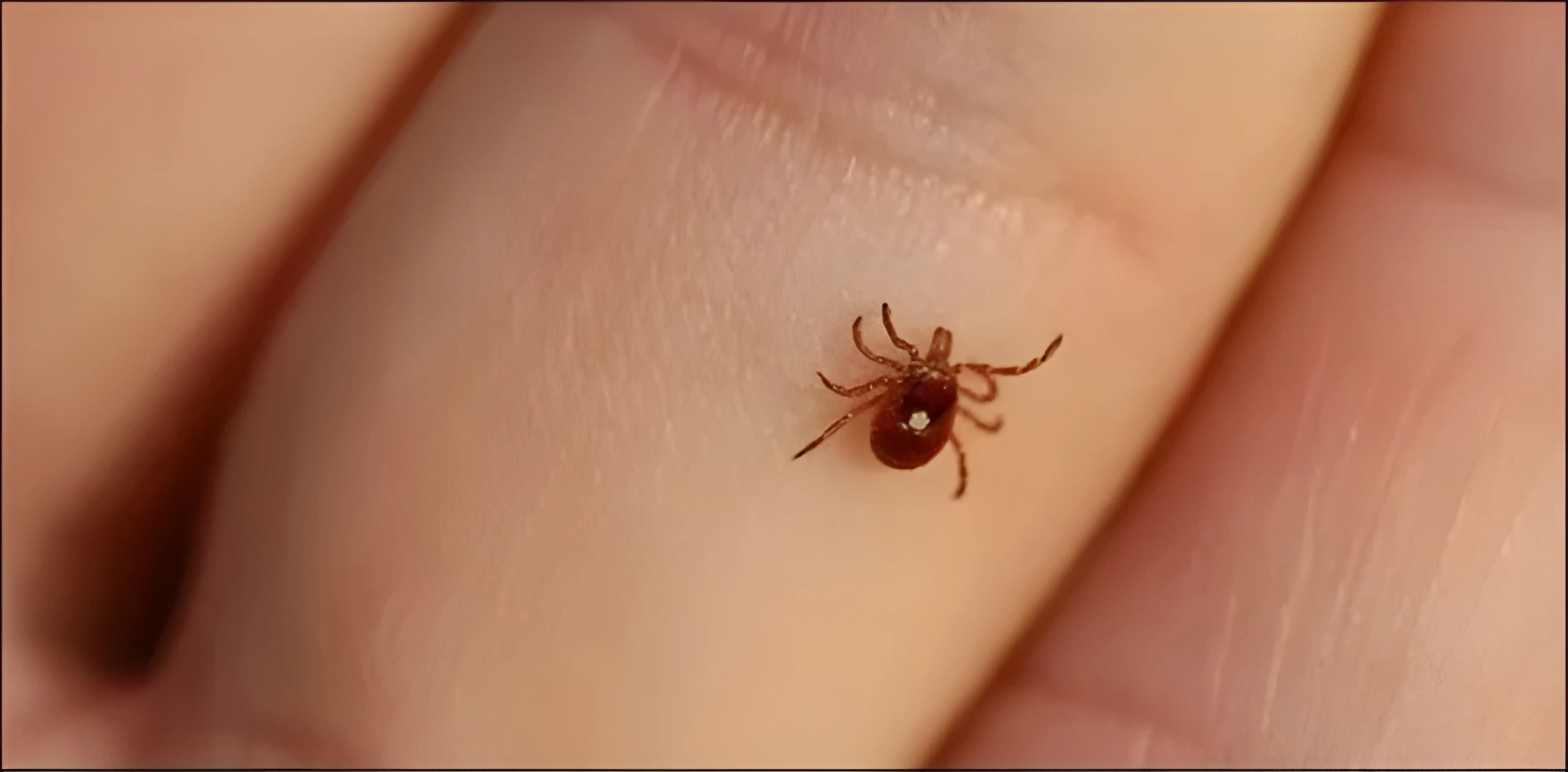 karachi-confirms-congo-virus-case-from-quetta