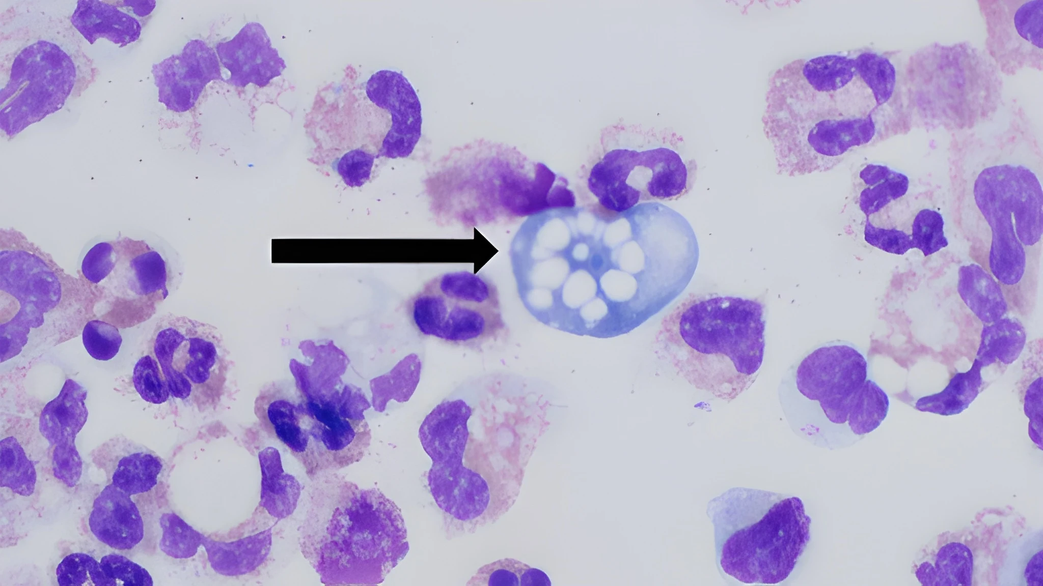third-naegleria-death-reported-in-karachi